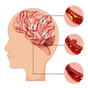 Stroke Awareness